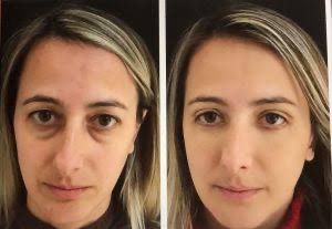 Antes e Depois - Elimina bolsas